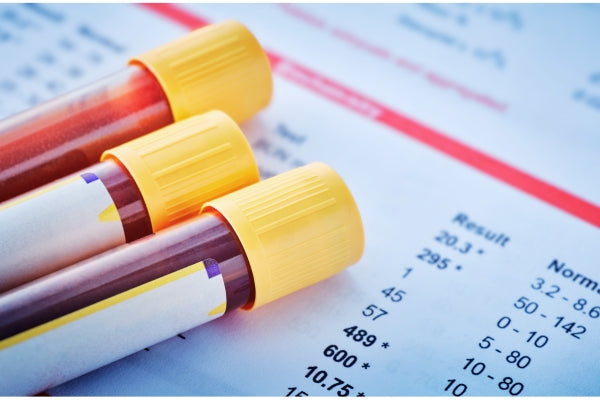 Three blood sample tubes with yellow caps on a medical chart background