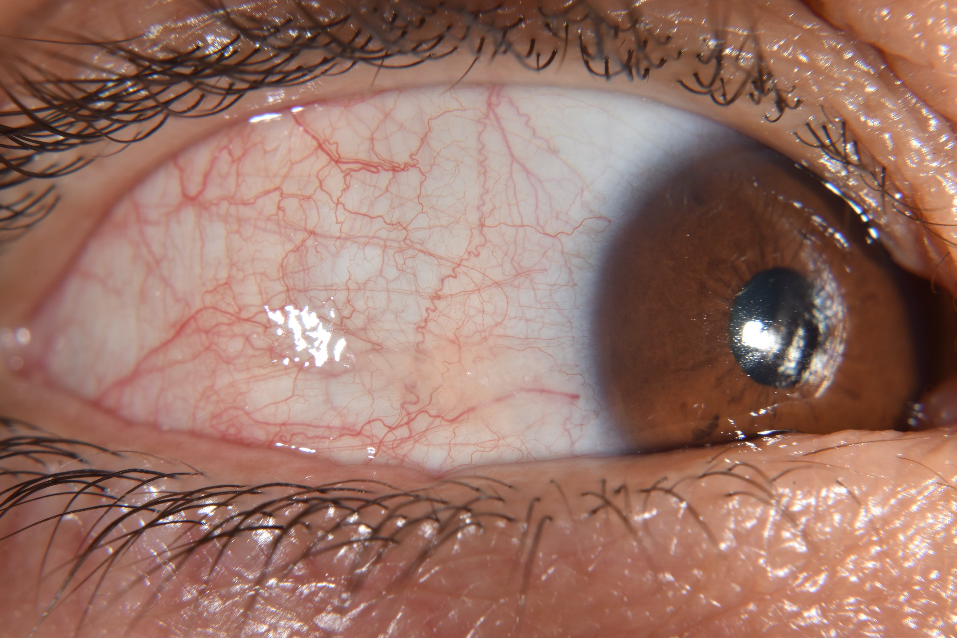 Close-up of a brown eye with visible blood vessels and a metallic object on the cornea.