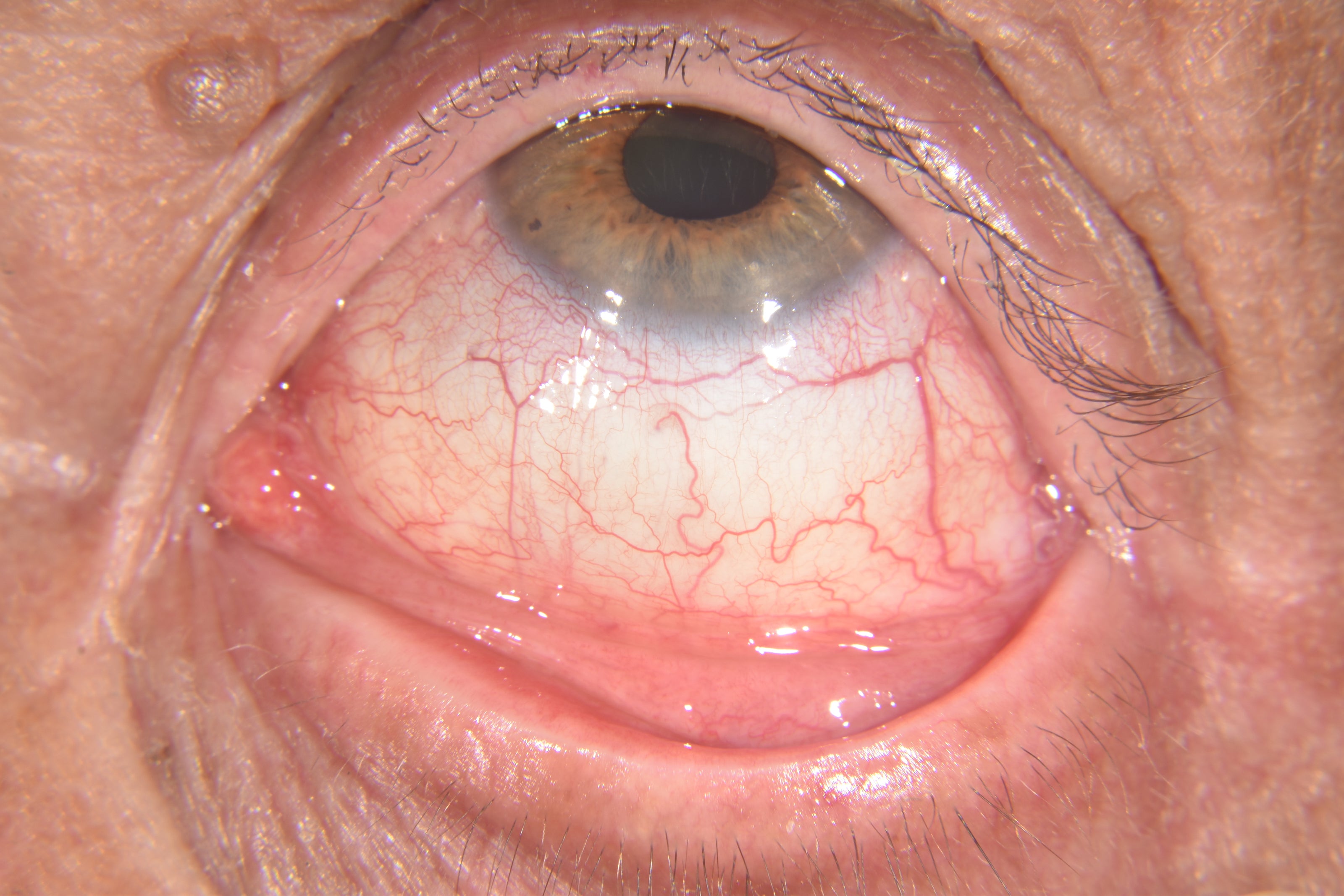 Close-up of a human eye with a very pink sclera.