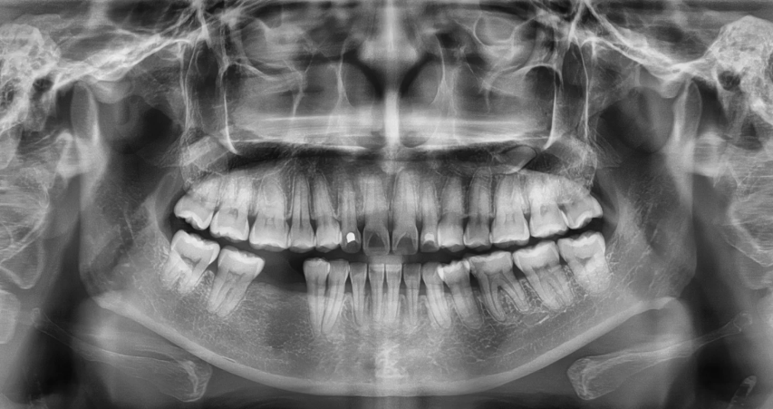 Dental X-ray of a patient's mouth showing teeth and jaw structure.
